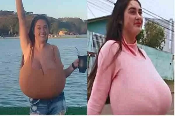 வளர்ந்து கொண்டே இருந்த மார்புகள்! மருத்துவ உலகையே அதிரவைத்த 22 வயது பெண்! வீடியோ